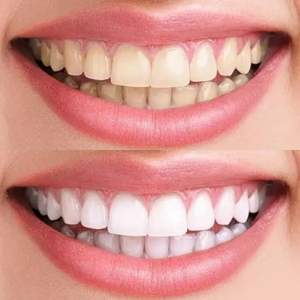EasySmile™ bleekmiddel